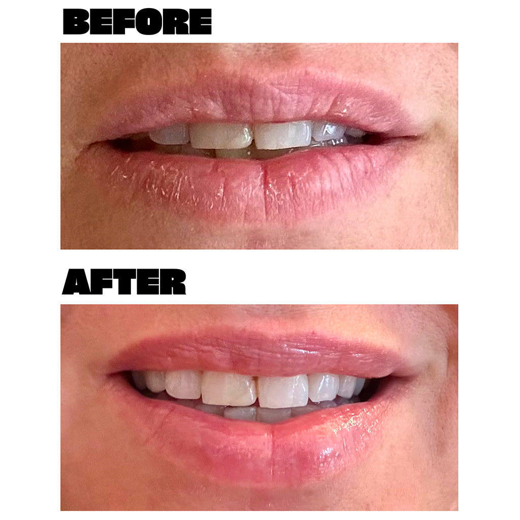 Babe Original Lip Mask (11g) - Model Shot Before & After